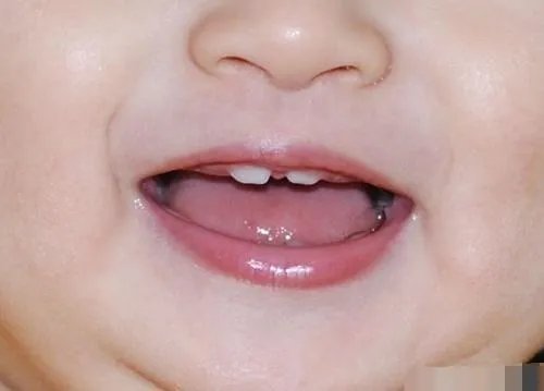 宝宝牙缝宽，都可以塞硬币了，但为什么医生说是好事？