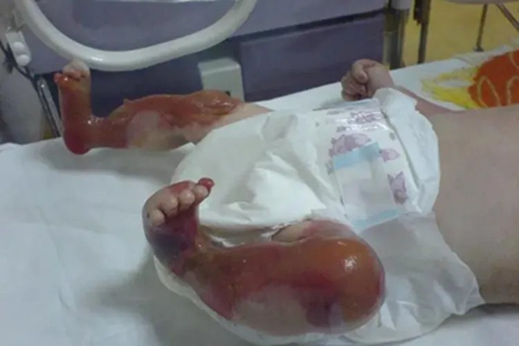 获得性大疱性表皮松解症腿脱皮图片