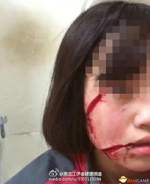 16岁女孩放学路上遭人毁容 右脸被划两刀惨不忍睹