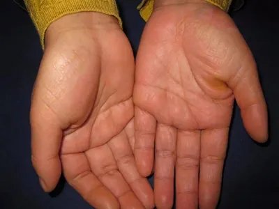 表皮松解性掌跖角皮症手掌皮肤增厚图片