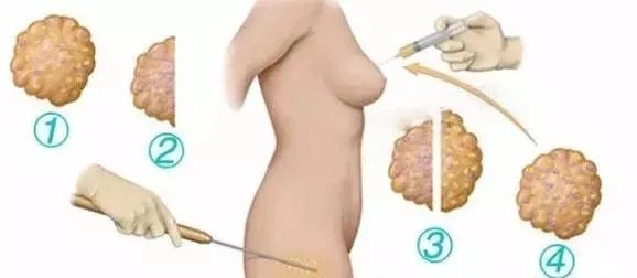 北京自体脂肪隆胸好不好