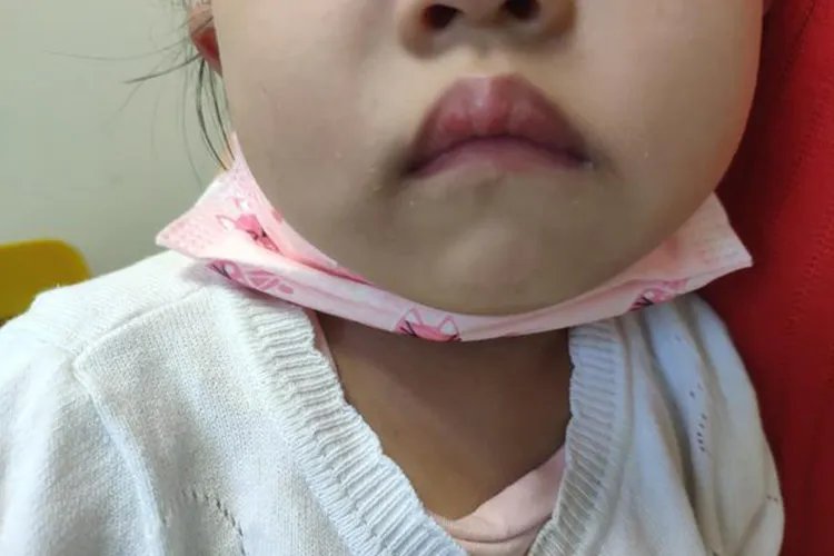 4岁娃腺样体肥大面容照片