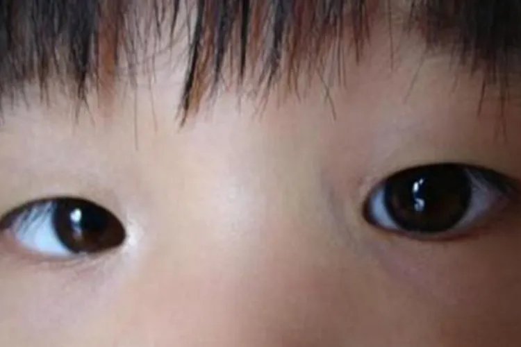 脑瘫的症状图片