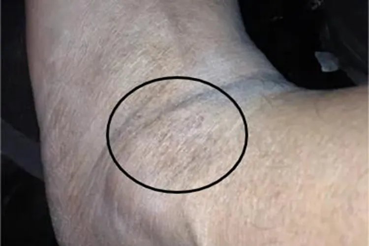 家族性进行性色素沉着脚踝斑图片