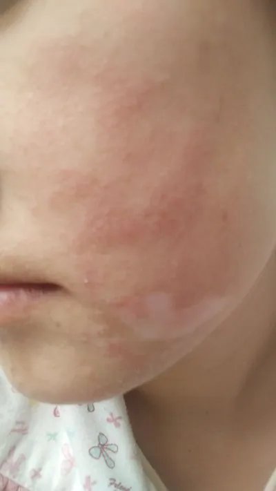 湿疹最佳治疗方法