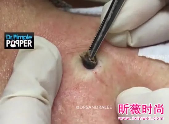 3年黑头被拔出 过程太吓人（图）