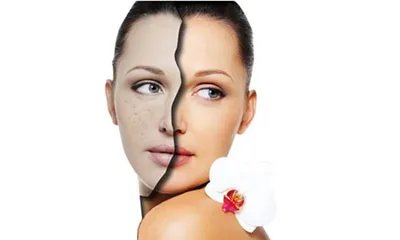 生活中常用祛斑的小窍门