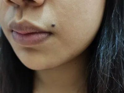 交界痣口周症状图片