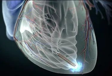 地精起搏器和地精起搏器XL是一次性的还是什么