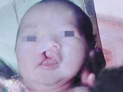 先天性外胚叶发育不良缺损图片