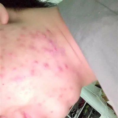 怎样治疗痤疮疤痕