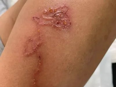 皮肤幼虫移行症渗液图片