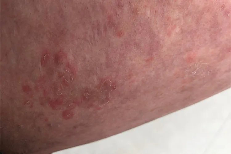 大腿内侧红疙瘩瘙痒图片