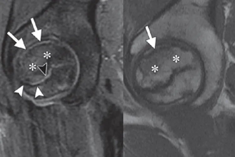 股骨头坏死核磁影像图